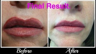 Lip tattoo CorrectionRemoval [upl. by Aneehta432]