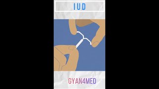 IUD insertion [upl. by Cirri]