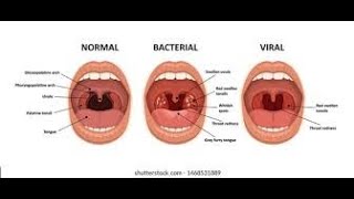 Pharyngitis Part 1 Viral Pharyngitis [upl. by Ycnaffit]