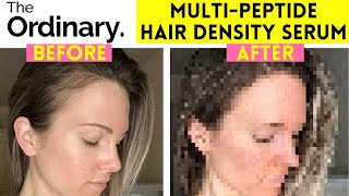 THE ORDINARY MULTIPEPTIDE SERUM FOR HAIR DENSITY REVIEW  BEFORE AND AFTER  6 MONTH UPDATE [upl. by Suryc]