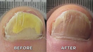 Nail Fungus Zap It with New Laser Treatment [upl. by Klement349]