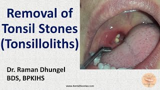 Warning signs of tonsillitis  Dr Sriram Nathan [upl. by Airrej]