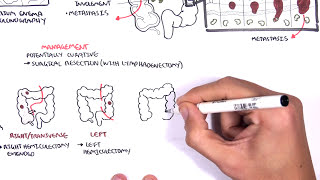 Colorectal Cancer  Overview [upl. by Yhtomiht]