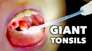 GIANT TONSILS  Strep Throat  Dr Paul [upl. by Enra690]