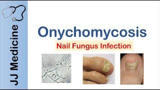 Onychomycosis  Nail Infection  Signs Symptoms Treatment [upl. by Reddin]