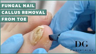 Fungal Nail Treatment And Callus Removal  The Foot Scraper DG Podiatrist [upl. by Shanda]