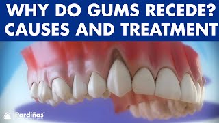 Gum recession  Treatment of gingival retraction © [upl. by Dailey]