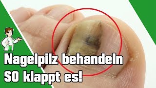 Nagelpilz behandeln  SO klappt es 👣💅 [upl. by Kentigerma]