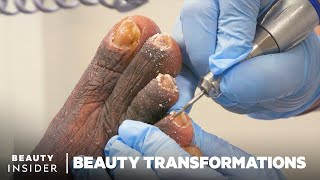 How Medical Pedicures Transform Feet [upl. by Arikehs]