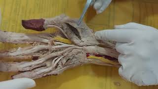 Dissection Muscles of Hand [upl. by Ezri649]