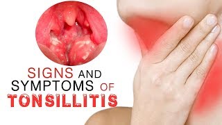 3D Medical Illustration of Tonsils  Tonsillitis Animation  ENT Animation [upl. by Romo]