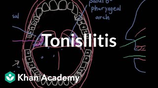 Urgent ENT Problems Peritonsillar Abscess [upl. by Irual554]