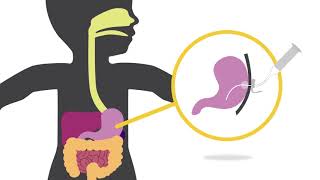 Feeding Tube Skills Replacing the Gastrostomy Tube [upl. by Ilbert]