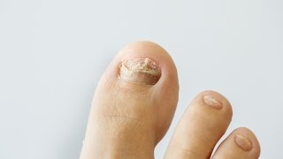 How to prevent and treat nail fungus [upl. by Selmner]