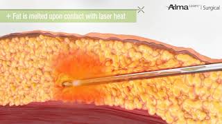 Laser Liposuction [upl. by Haraz]