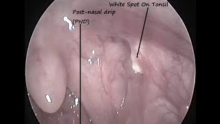 Causes amp treatment of Tonsil infections  Dr Deepanshu Gurnani [upl. by Kling]