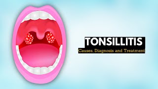 Tonsils  Clinical Anatomy Palatine lingual tubal adenoids [upl. by Morrison]