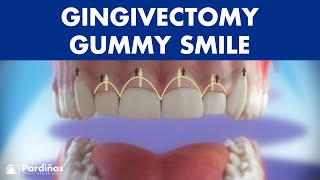 Gingivectomy  Treatment for gummy smile © [upl. by Xela]