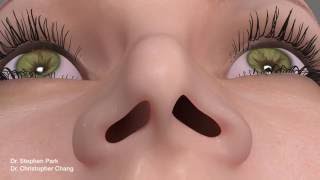 Pinched Narrow Nose Rhinoplasty to Address Nasal Obstruction [upl. by Spracklen662]