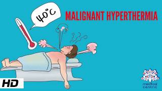 MALIGNANT HYPERTHERMIA Causes Signs and Symptoms Diagnosis and Treatment [upl. by Mahau]