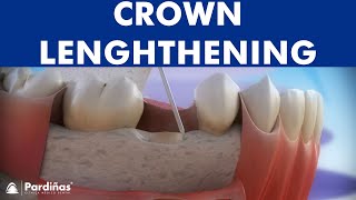 Dental crown lengthening © [upl. by Oeak267]