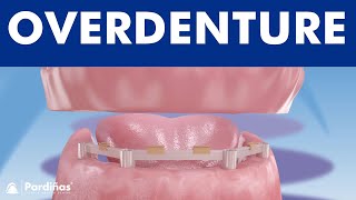 Overdenture with dental implants © [upl. by Ppilihp]