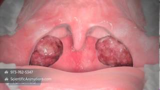 Tonsillitis Causes Signs and Symptoms Diagnosis and Treatment [upl. by Winton]