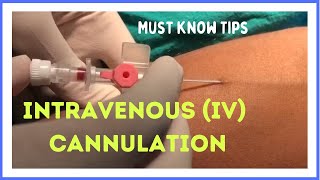 INTRAVENOUS IV CANNULATION in 5 mins How to insert [upl. by Adnoek]