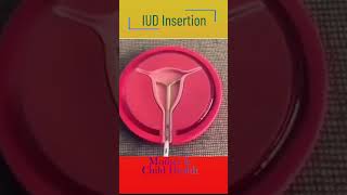 Understanding IUD Types Effectiveness and Side Effects [upl. by Franni303]