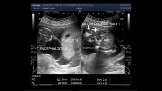 Monitoring Babies with Abdominal Wall Defects Before Birth Omphalocele and Gastroschisis 5 of 11 [upl. by Tomi]