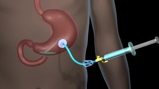 Understanding Tracheostomy Tubes National Tracheostomy Safety Project [upl. by Normac]